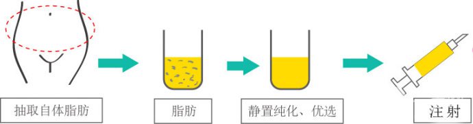 自體脂肪填充疼嗎 自體脂肪填充怎樣