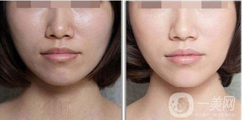 鐳射激光嫩膚是什么 主要有哪些作用？