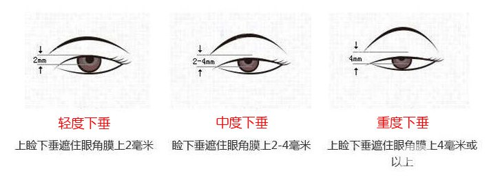上瞼下垂矯治術(shù)*果怎么做 保持多久？