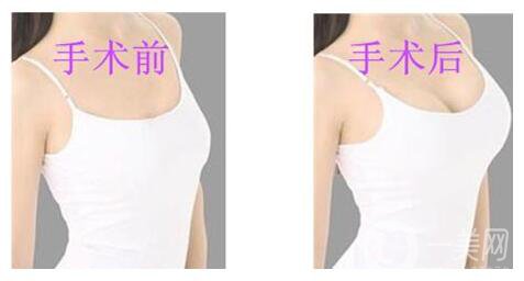 假體隆胸的恢復(fù)時間是多久？