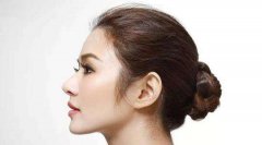 硅膠隆鼻果可以維持多久 硅膠隆鼻*嗎