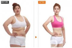 抽脂手術(shù)后需要多久恢復 果能維持多久