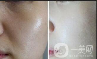 光子嫩膚價格