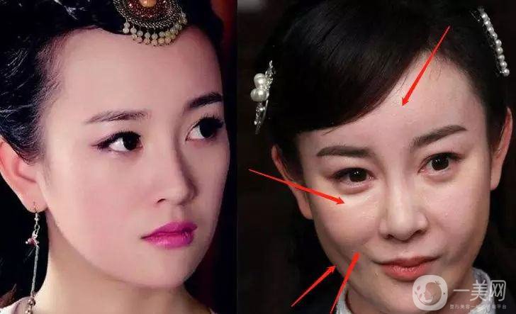 明星整容就是不承認(rèn)？ 然后突然臉“爛”了！