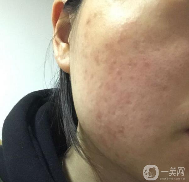 果酸換膚*果