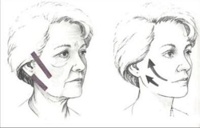 熱瑪吉除皺價(jià)格是多少錢 熱瑪吉*果怎么樣