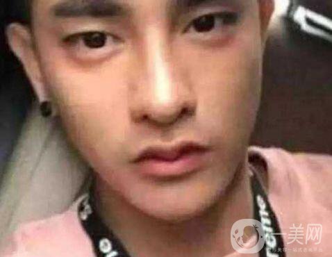 小伙整容數(shù)十次，只為一張韓星臉