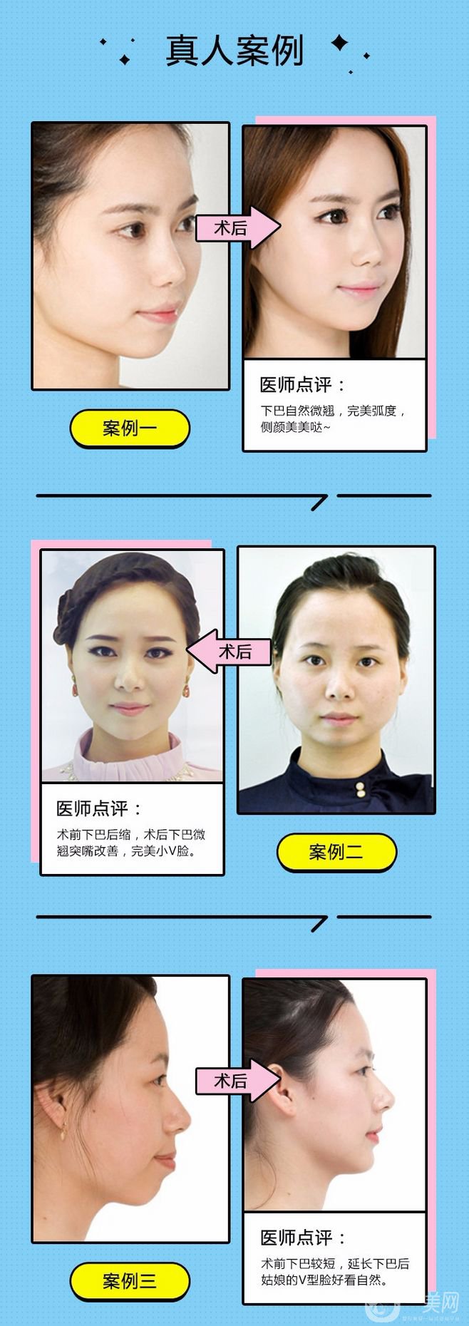 墊下巴都有哪些方式呢？墊下巴前后圖