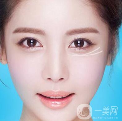 注射去皺后時(shí)間久了皺紋會(huì)變得更糟嗎？