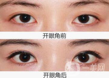 開眼角注意事項,開眼角