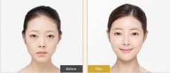 開內(nèi)外眼角果如何？開眼角前后照片