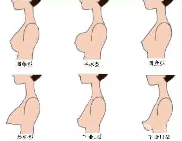 隆胸術(shù)后注意事項 隆胸有副作用嗎