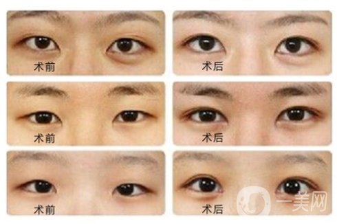開眼角前后