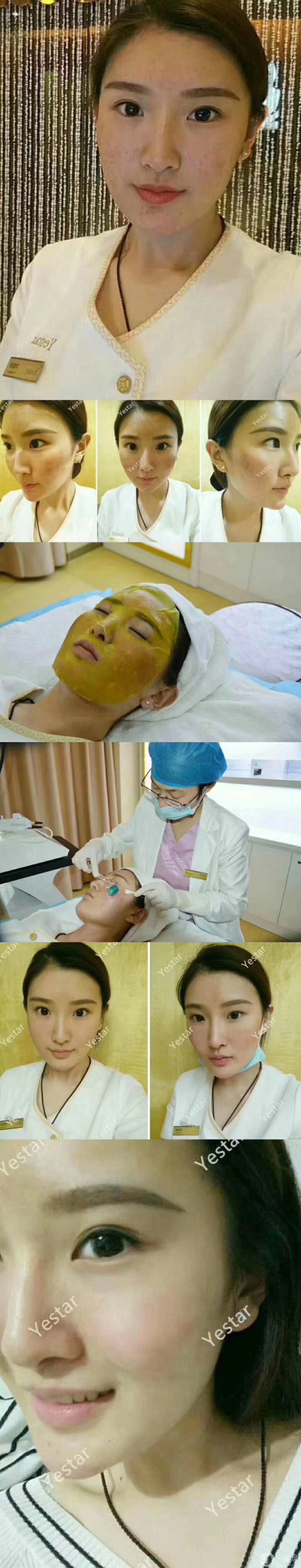 磨皮祛痘坑*果好嗎？去痘坑前后