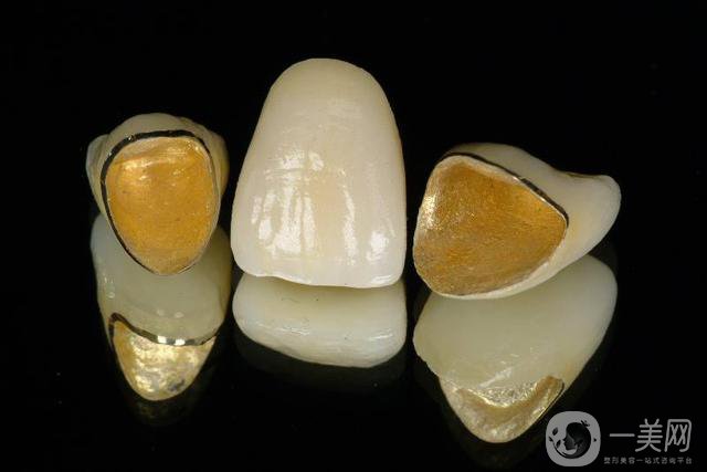 黃金烤瓷牙價(jià)格一般是多少？