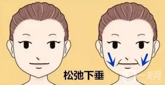 法令紋怎么祛除*果比較好？