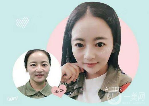 關(guān)于注射美容，你得了解這幾點(diǎn)干貨！