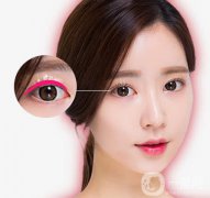 亞韓割雙眼皮多少錢？什么人不適合做這項手術呢？