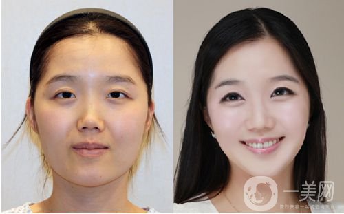 班加羅爾面部頸部抽脂術(shù)怎么樣 價格是多少？