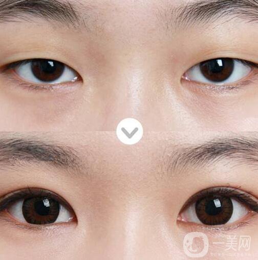 三點定位雙眼皮,三點定位雙眼皮眼睛疼嗎