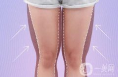 女性大腿吸脂一般多久恢復?*嗎?