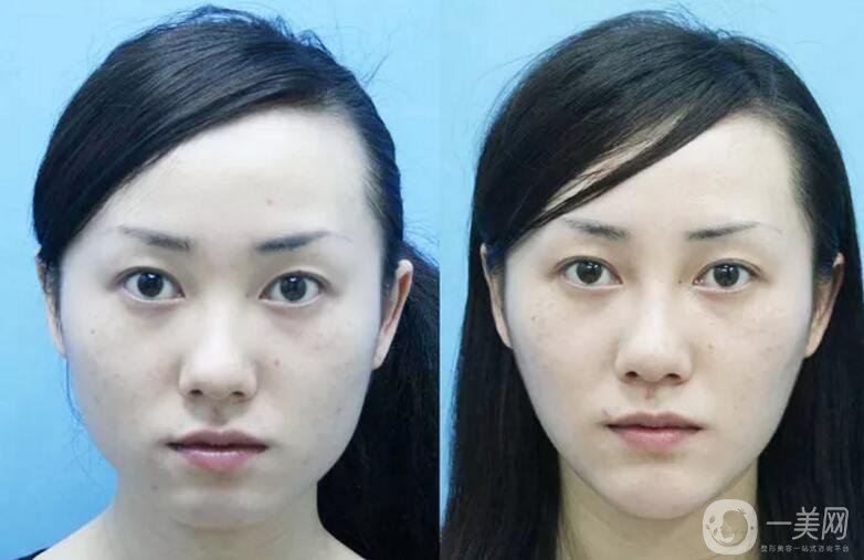 下頜角磨骨整形價格貴嗎？需要多少錢？