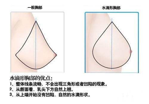 水滴隆胸*果圖 水滴隆胸好不好
