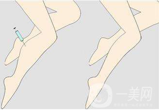 射頻瘦小腿優(yōu)缺點(diǎn)有哪些 射頻瘦小腿方法