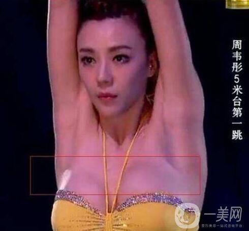 周韋彤整容