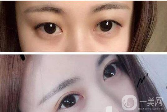雙眼皮術(shù)后注意事項(xiàng)