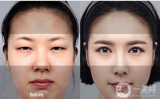 一般割雙眼皮多少錢？影響價(jià)格的因素有哪些？