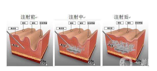 注射伊維蘭除皺后應(yīng)該要注意哪些問題呢?