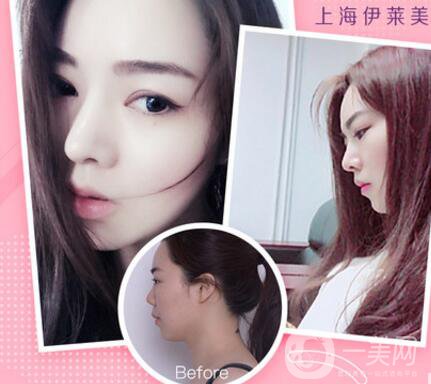 上海伊萊美口碑怎么樣？是正規(guī)醫(yī)院嗎？