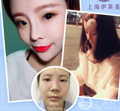 上海伊萊美口碑怎么樣？是正規(guī)醫(yī)院嗎？