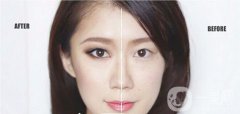 重慶做雙眼皮要多少錢(qián) 割雙眼皮有風(fēng)險(xiǎn)嗎