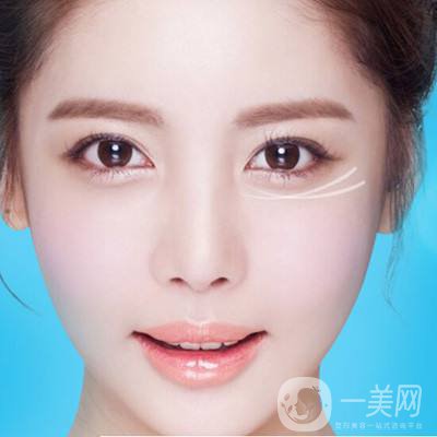 深圳去眼袋手術(shù)多少錢 去眼袋有什么風險嗎？