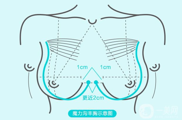沃斯堡豐胸術(shù)怎么樣 隆胸的風(fēng)險有多大？