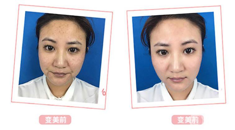 光子嫩膚*果介紹？對皮膚會有傷害嗎？