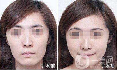 臉頰隆起的原因是什么 手術(shù)怎么做？