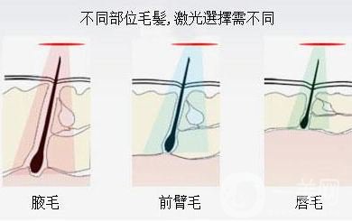 激光脫毛怎么樣 激光脫毛的工作原理
