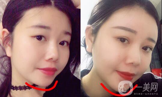 自體脂肪墊下巴恢復(fù)期是怎樣的？如何做好術(shù)后護(hù)理？