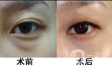 超聲波去眼袋