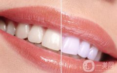 冷光美白牙齒的價(jià)格 冷光美白牙齒持久嗎