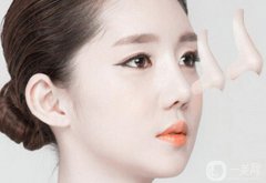 隆鼻哪種好 該如何選擇適合自己的方式？