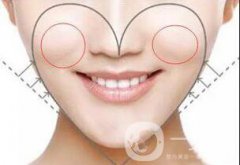 自體脂肪豐蘋(píng)果肌貴嗎 多少錢(qián)