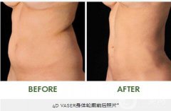 4D體輪廓吸脂術(shù)是什么?果怎么樣？