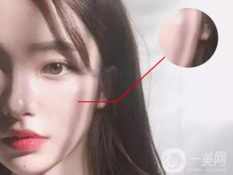 磨顴骨*果怎么樣 有什么風險嗎？