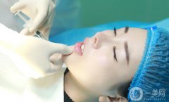 自體脂肪墊下巴貴嗎 一般多少錢？