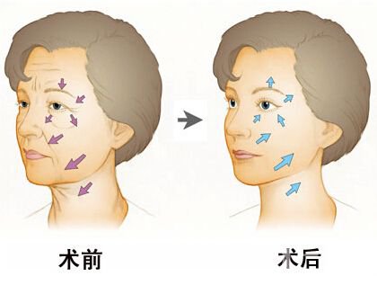 *去皺多少錢(qián) 除皺的方法有哪些