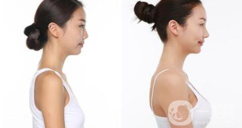 乳房下垂矯正手術貴嗎 乳房下垂矯正的方法